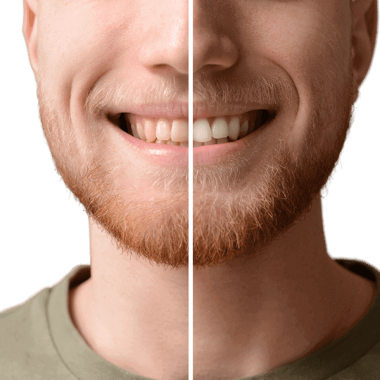 Tanden witmaken: dental bleaching